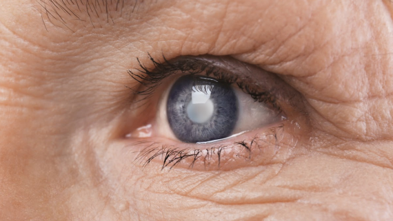 Retinopatia Diabetica Napoli